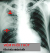 Dấu hiệu, nguyên nhân và điều trị bệnh viêm phổi thùy