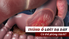 Có thể phòng tránh thủng ổ loét dạ dày