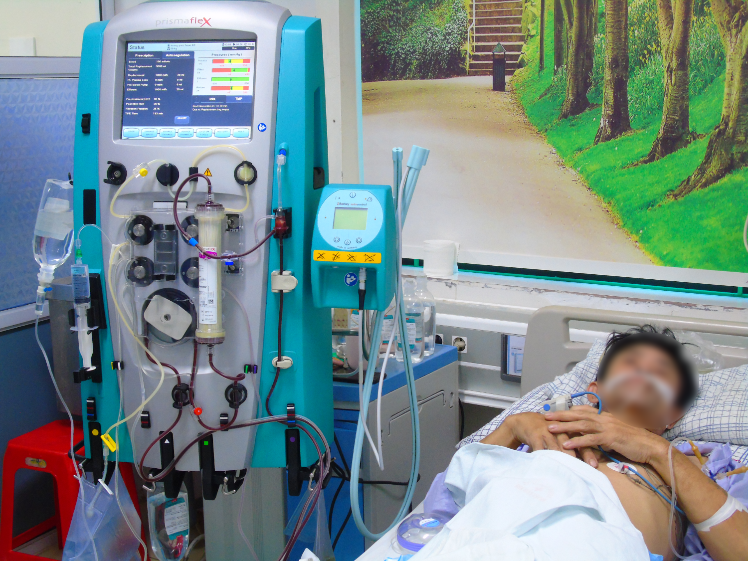 Lọc máu cấp cứu cho bệnh nhân viêm tụy cấp thể tăng triglycerid