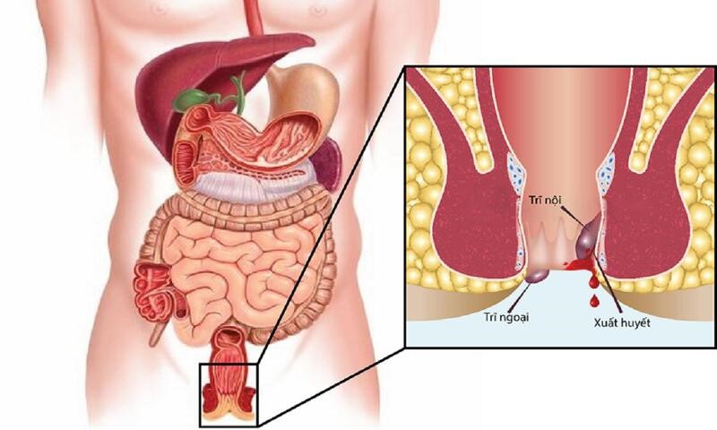GIẢM ĐAU, RÚT NGẮN THỜI GIAN ĐIỀU TRỊ KHI CẮT TRĨ BẰNG PHƯƠNG PHÁP LONGO