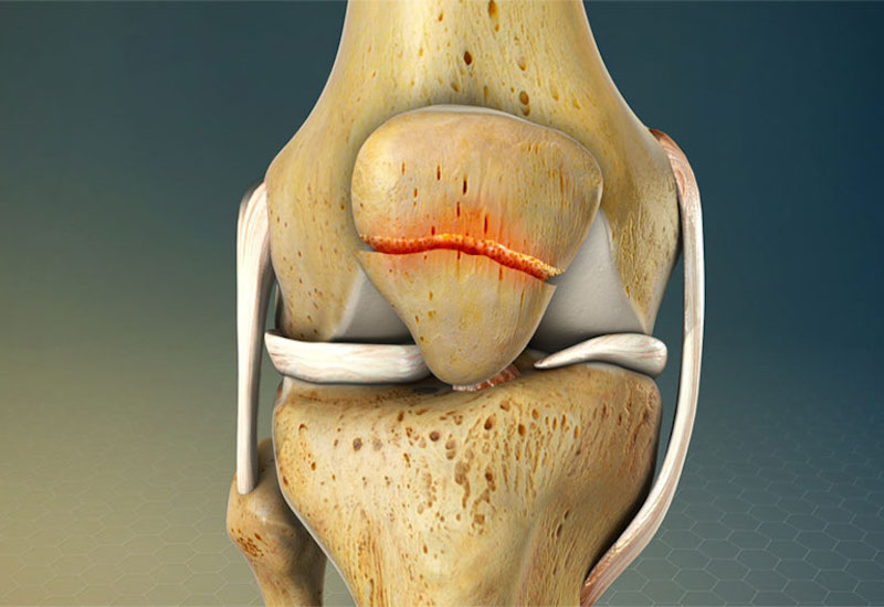 Thời gian phục hồi sau gãy xương bánh chè