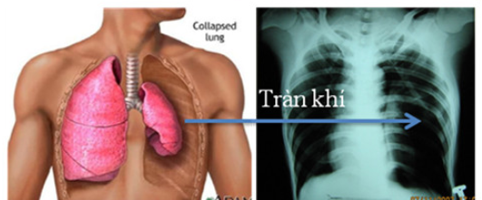 Tràn khí, tràn máu màng phổi