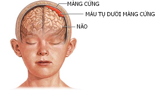 Phẫu thuật lấy máu tụ dưới màng cứng tại Trung tâm Y tế huyện Cẩm Khê