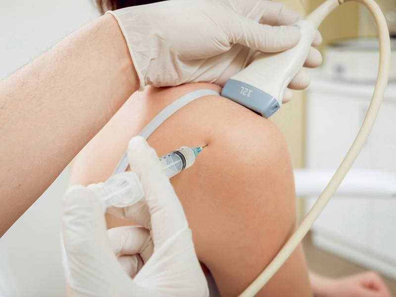 VIÊM QUANH KHỚP VAI - DẤU HIỆU NHẬN BIẾT, ĐIỀU TRỊ VÀ PHÒNG TRÁNH