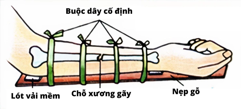 cac buoc so cuu va bang bo cho nguoi gay xuong cang tay 3 3b78485970