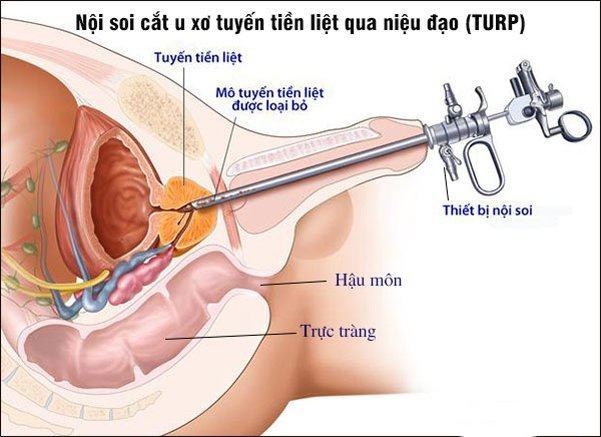 cat u phi dai lanh tinh tuyen tien liet qua noi soi