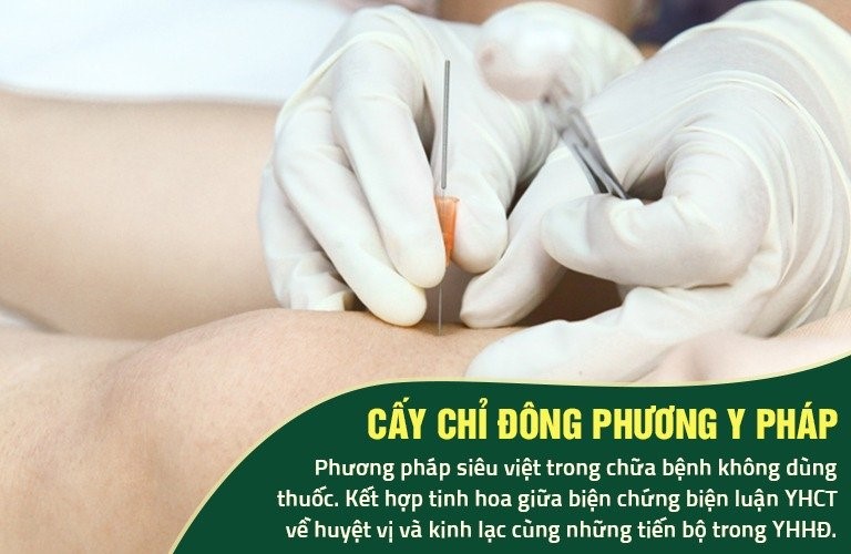 CẤY CHỈ - BƯỚC TIẾN MỚI CỦA KỸ THUẬT CHÂM CỨU