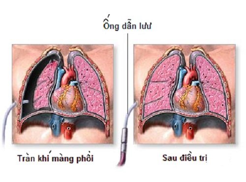 tran khi