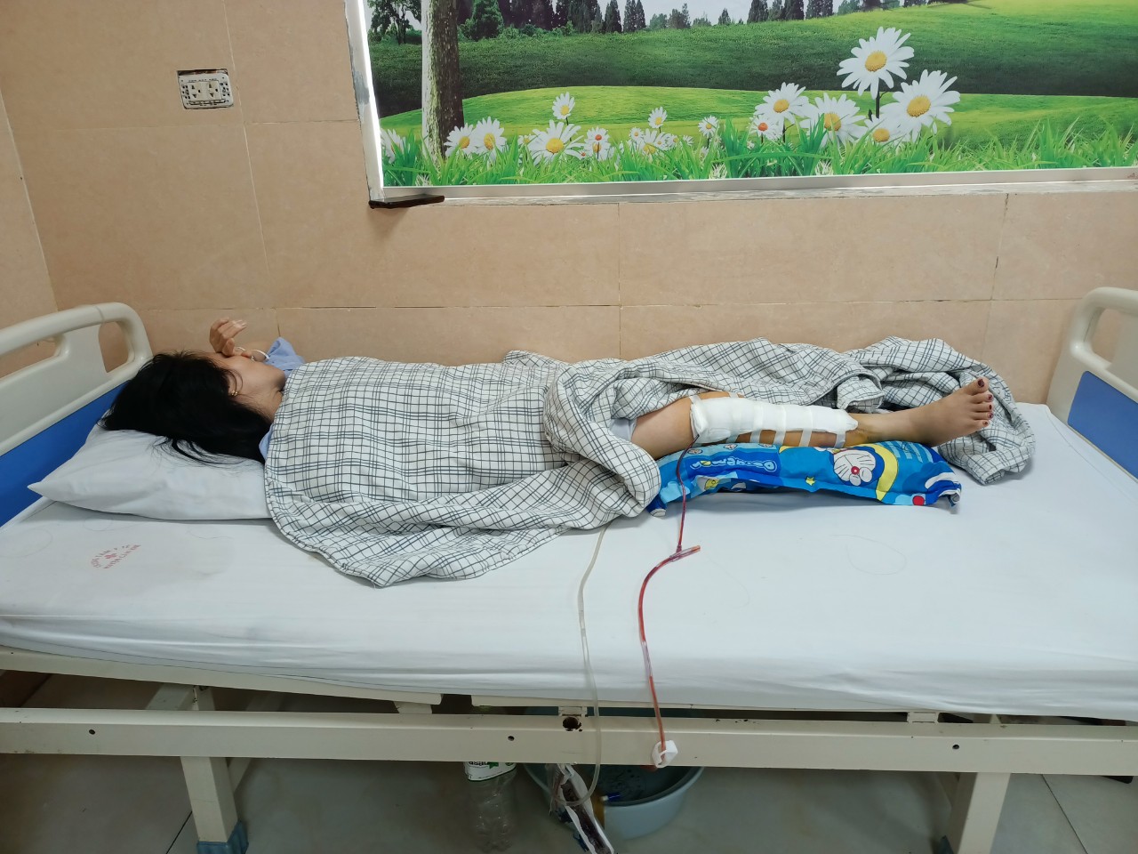 Phẫu thuật vỡ mâm chày Schatzker II bằng nẹp khóa