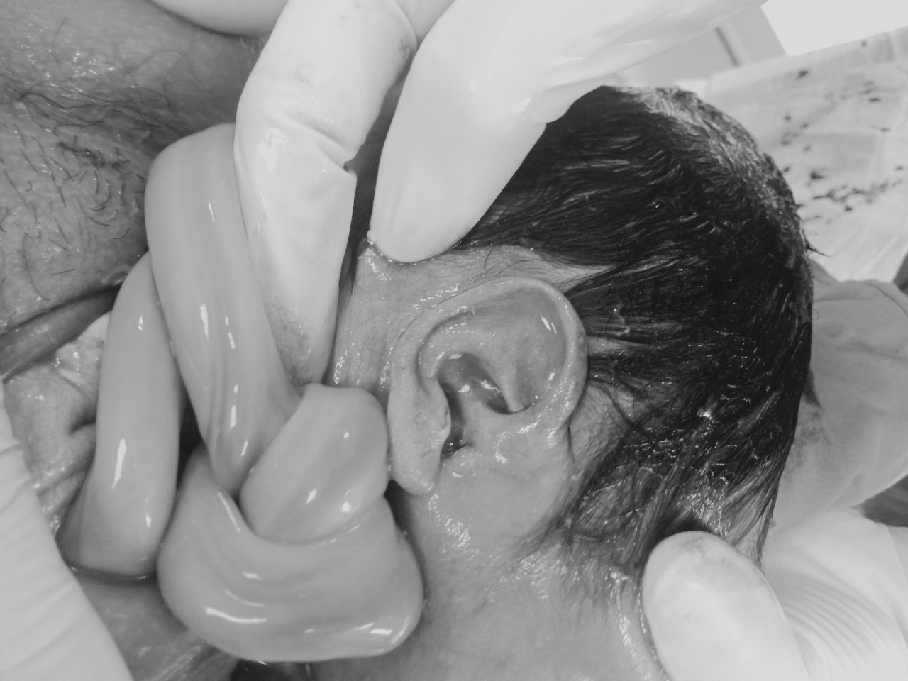Em bé sinh thường với 01 nút thắt dây rốn và 02 vòng rau cuốn cổ